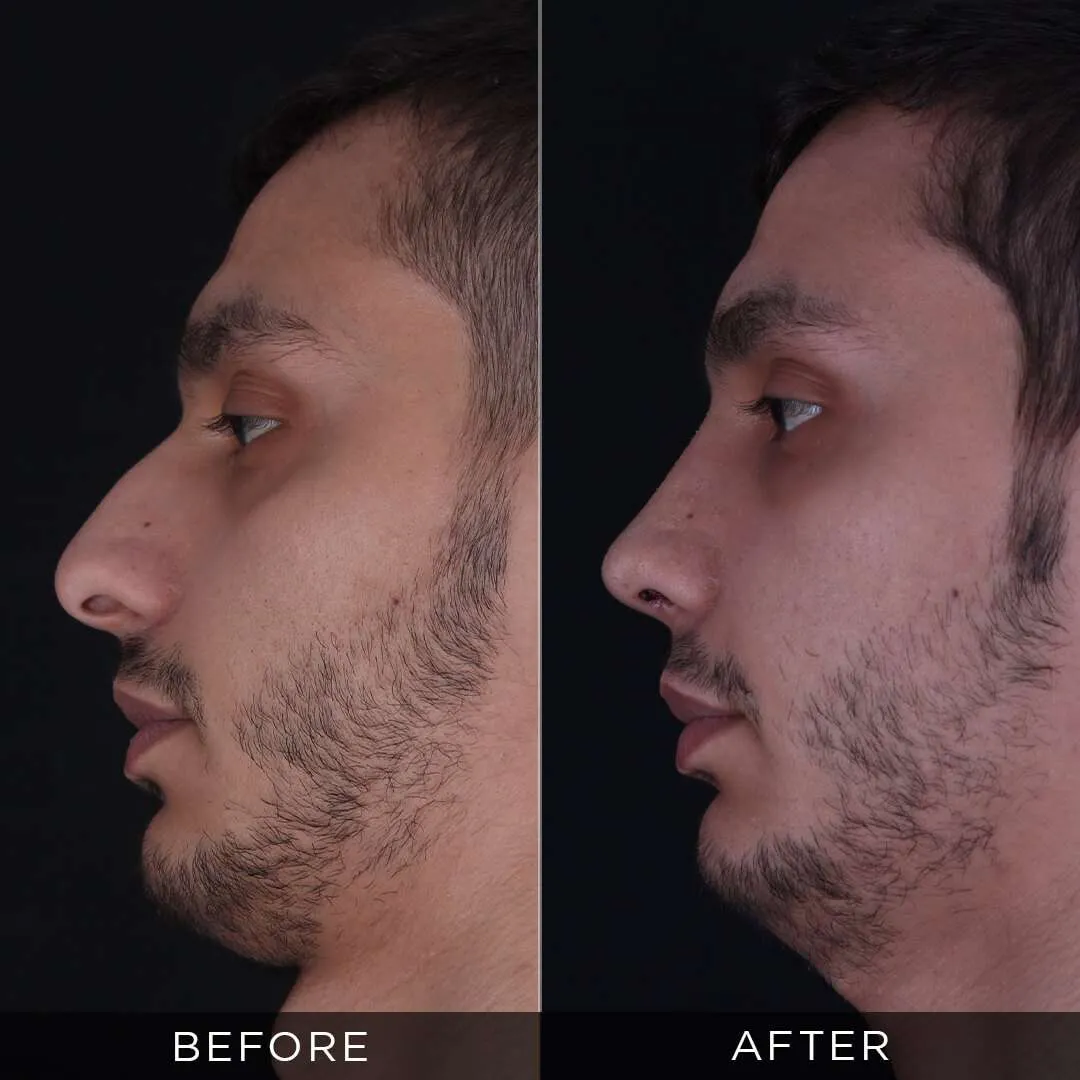 male rhinoplasty at the age of 26 in turkey
