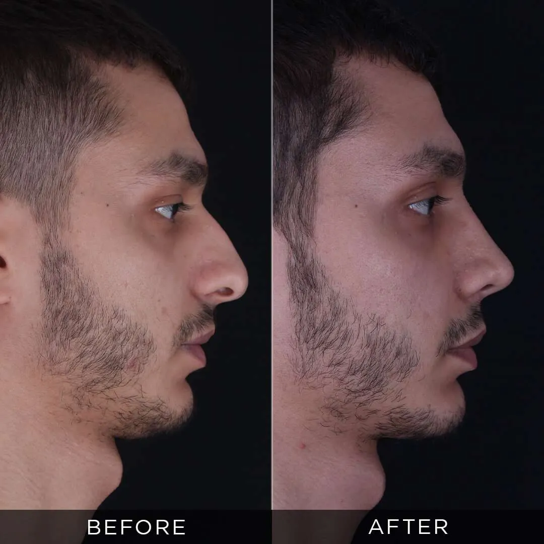 6 months after rhinoplasty at 26 years old