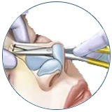 Tip Plasty Turkey piezo