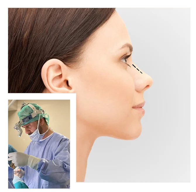 Revision Rhinoplasty in Turkey revision rhionplasty in istanbul