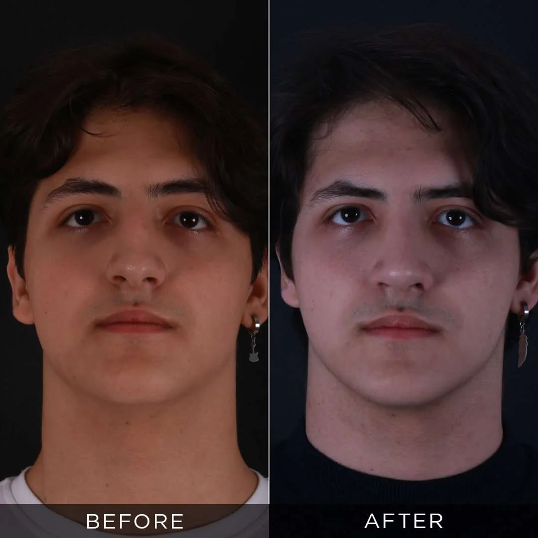 22 years old rhinoplasty 6 months after