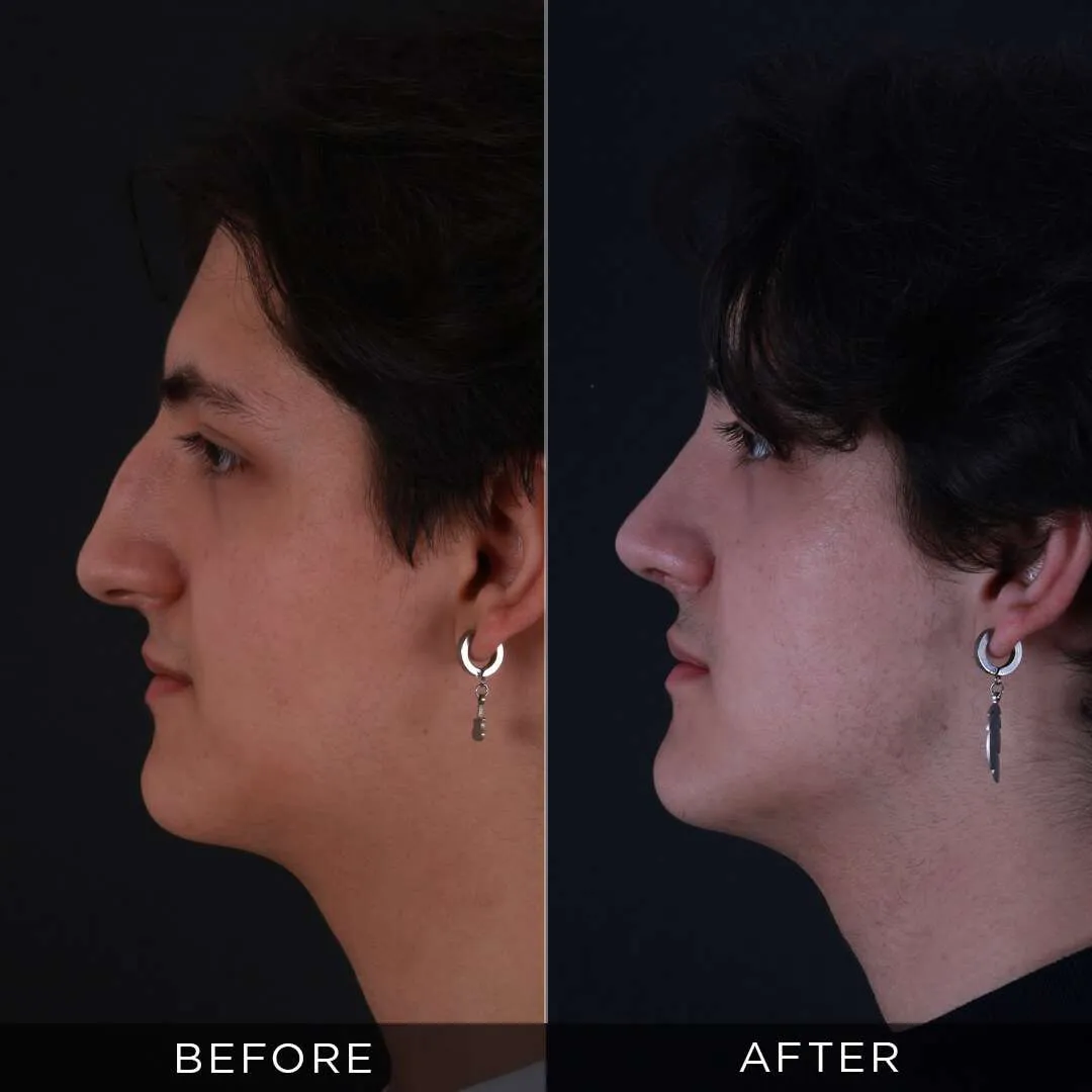22 years before and after rhinoplasty