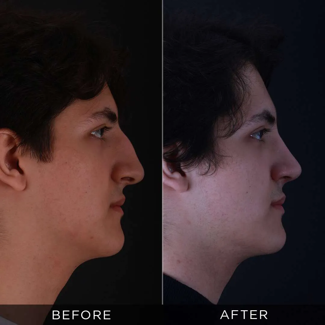 6 months after male rhinoplasty