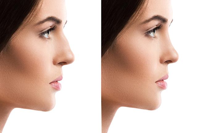 Piezo Rhinoplasty Turkey am-i-a-suitable-candidate-for-piezo-rhinoplasty_