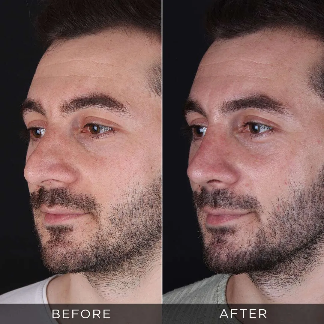 Before and after male rhinoplasty in Turkey