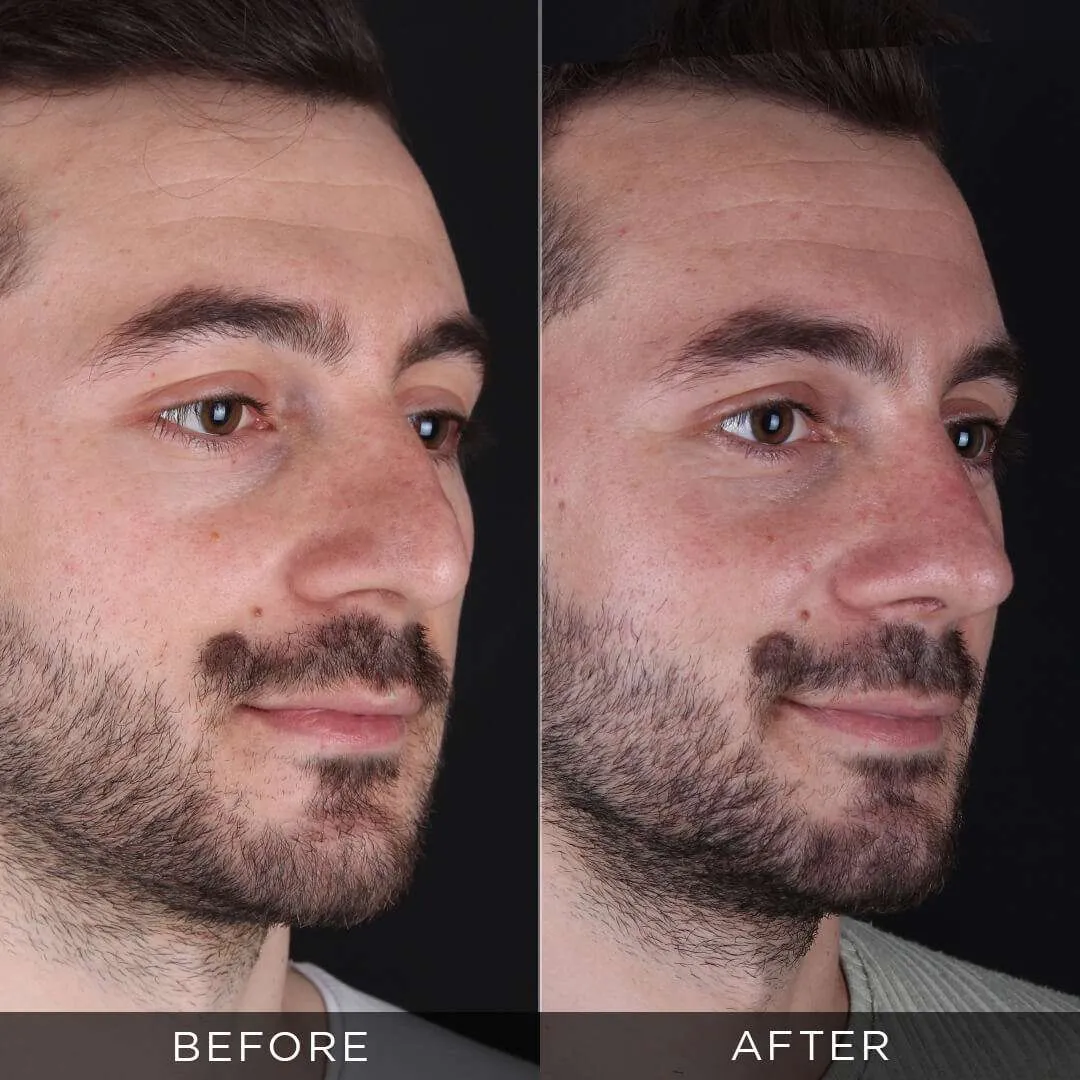 28 year old male rhinoplasty