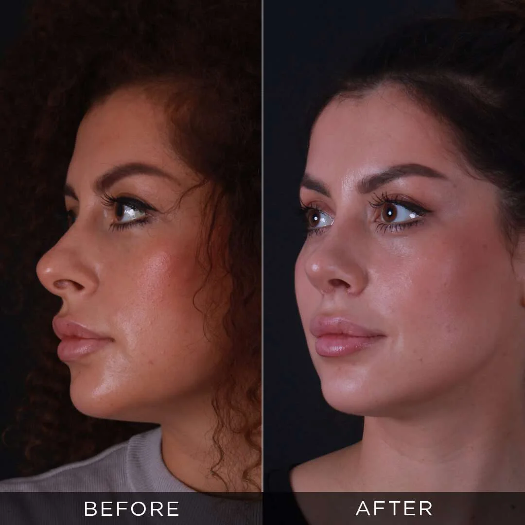 29 years old piezzo rhinoplasty