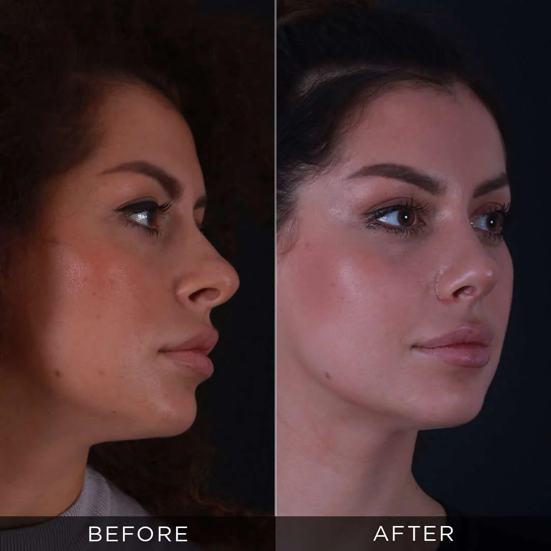 29 year old woman rhinoplasty