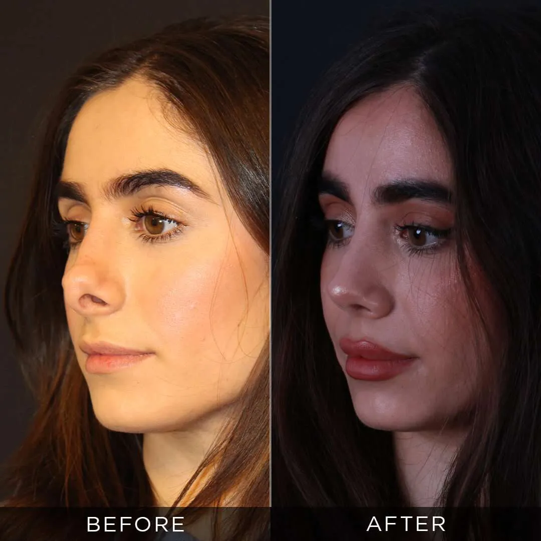 female revision rhinoplasty in istanbul