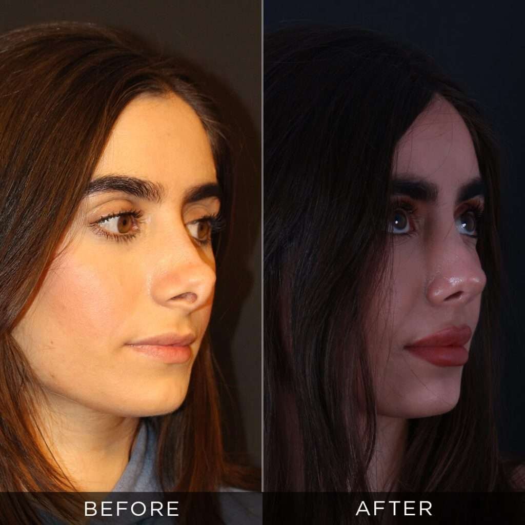 revision rhinoplasty 26 years old