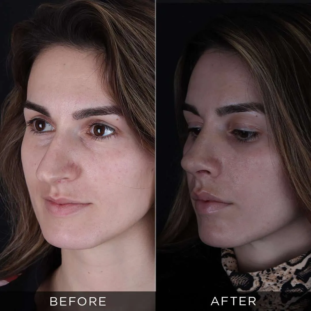 6 months after rhinoplasty at 28 years old