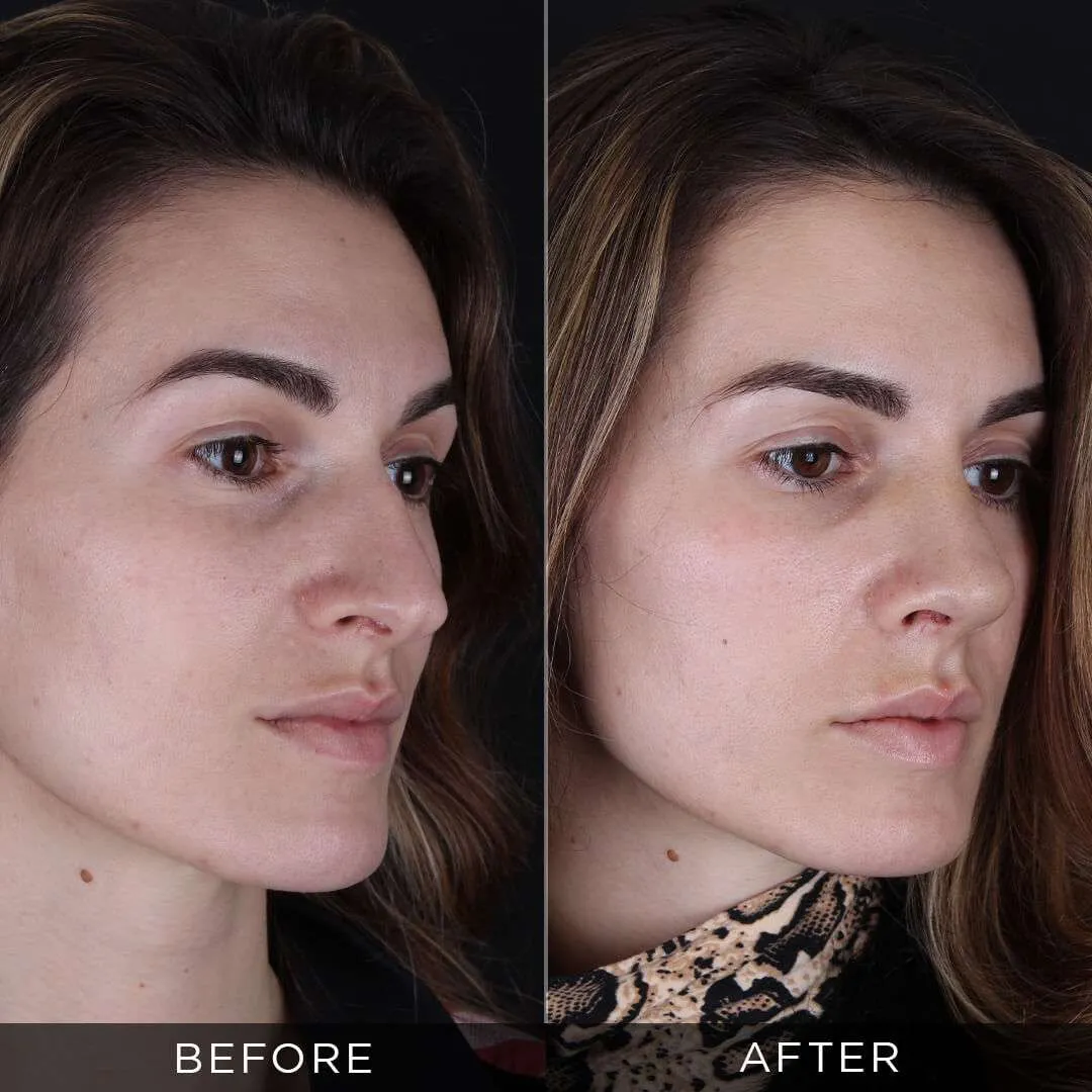female 28 years rhinoplasty