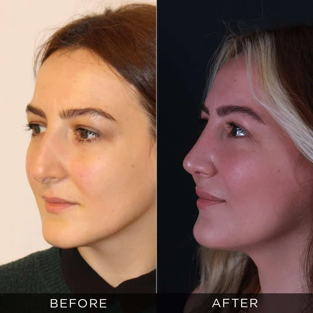rhinoplasty for female 35 years old in turkey