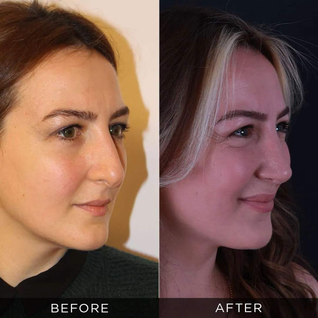 Rhinoplasty for 35 year old woman