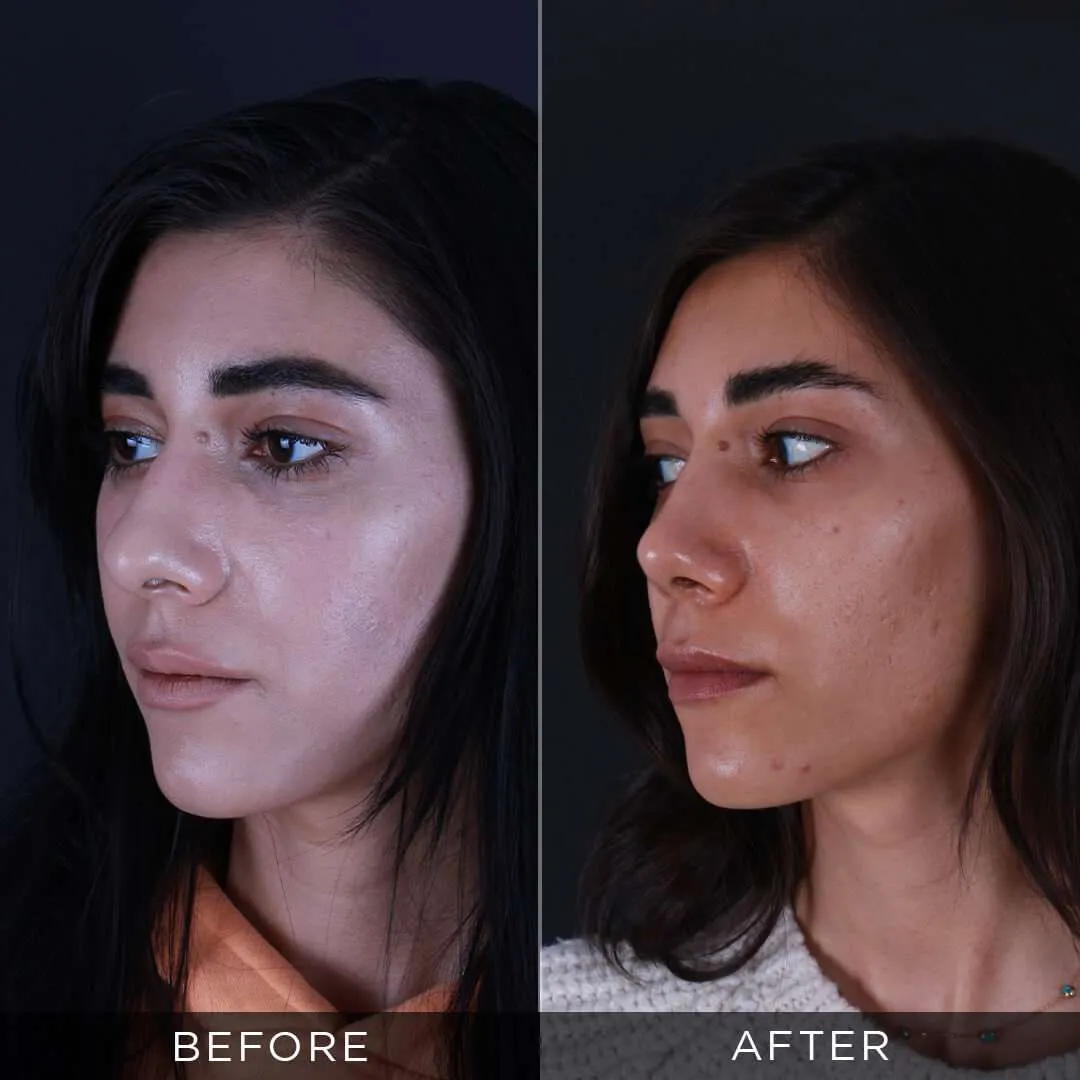 before-after-rhinoplasty-turkey