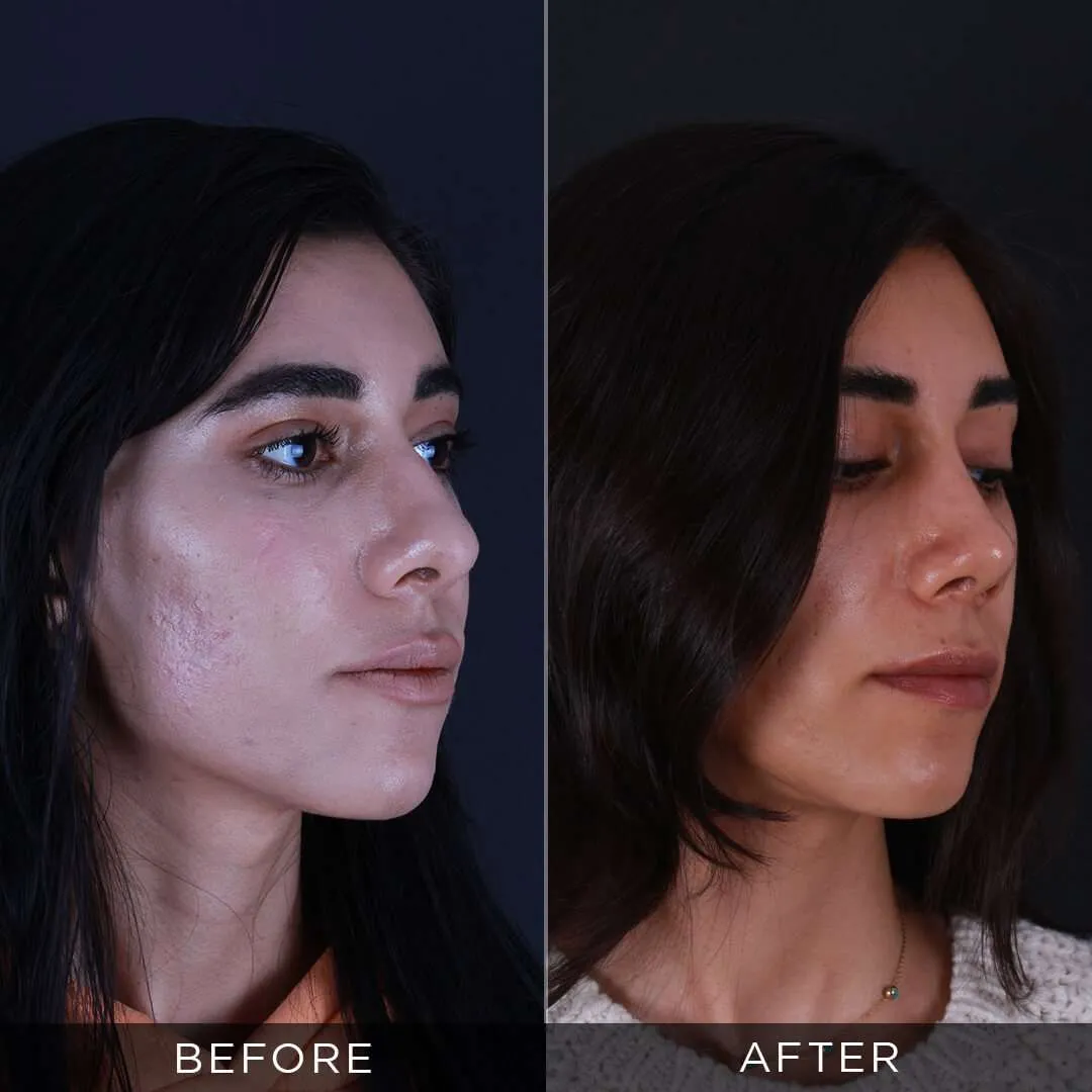 Rhinoplasty Before & After Gallery