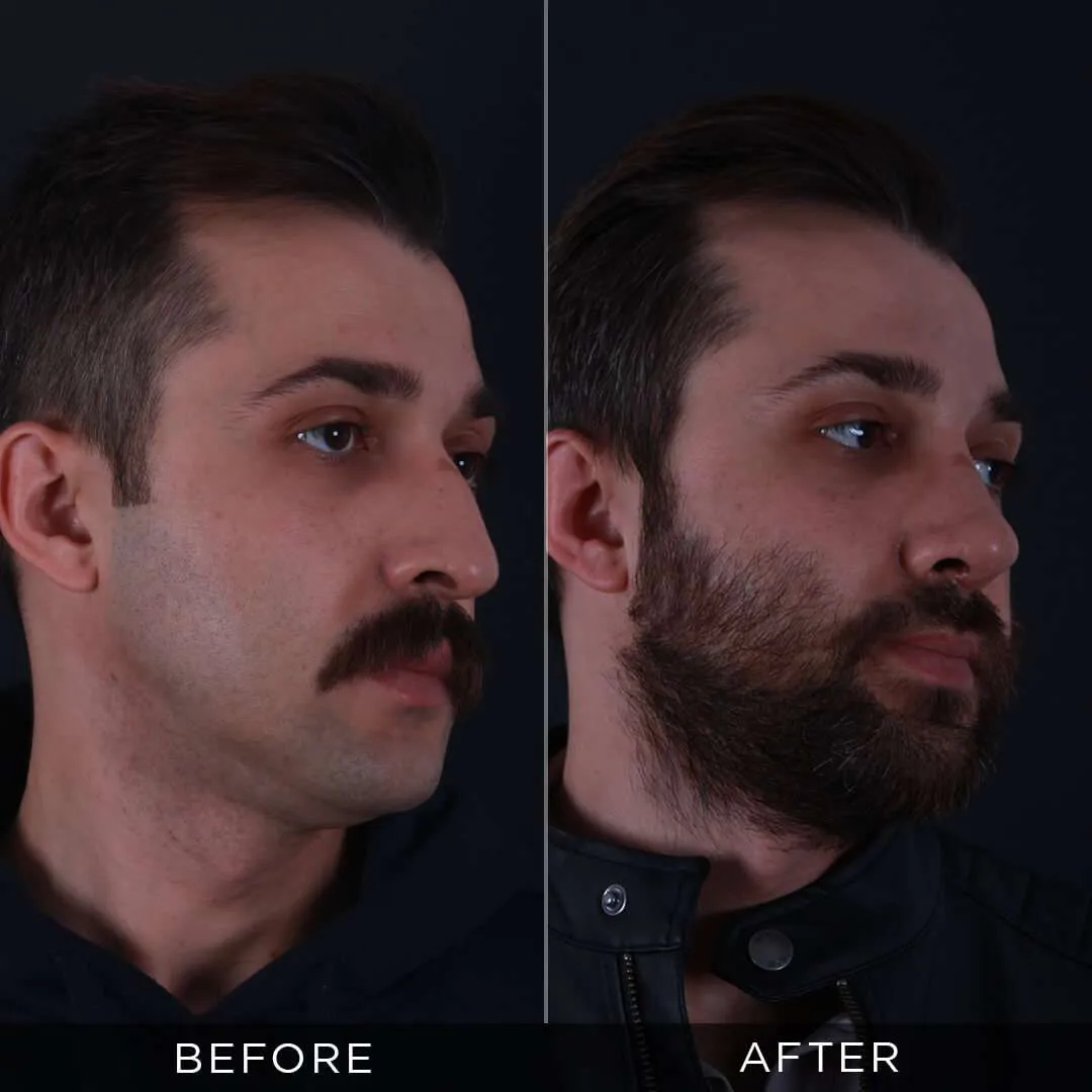 31 year old male rhinoplasty