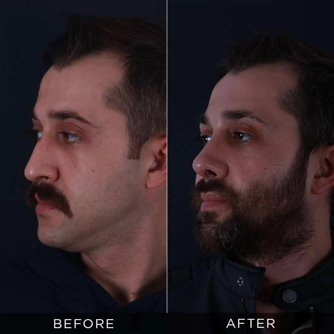 31 year old male rhinoplasty in Turkey