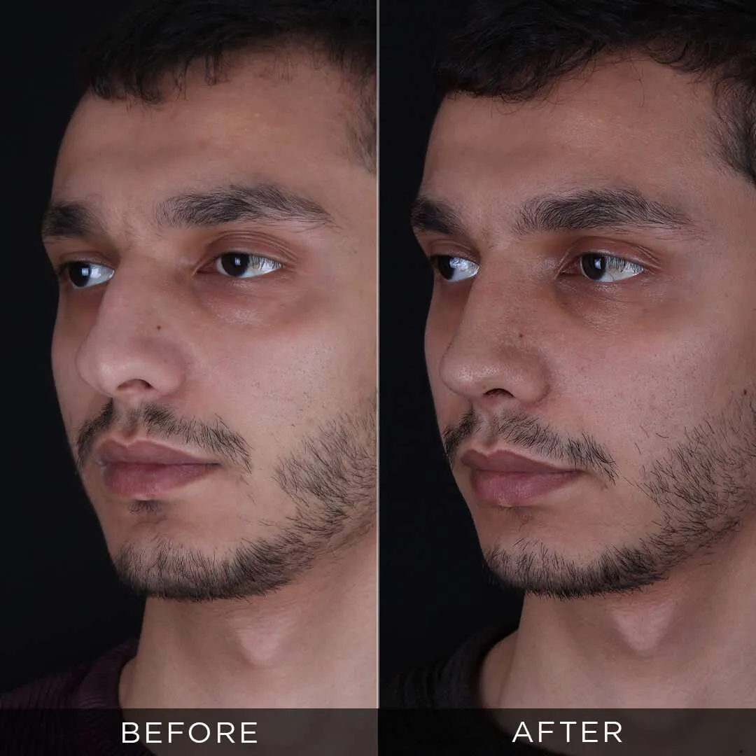 male-rhinoplasty-in-turkey-istanbul