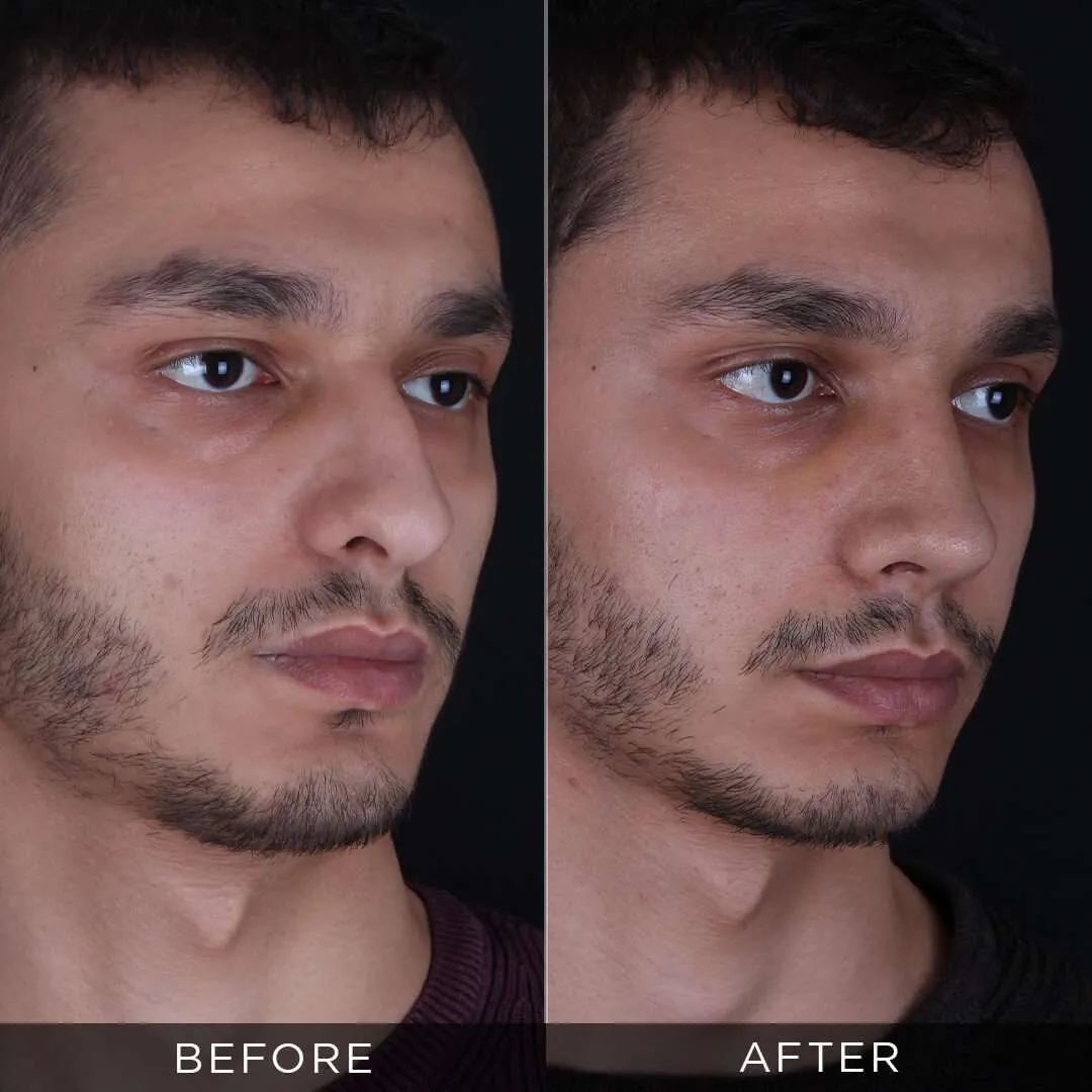 male-before-and-after-rhinoplasty