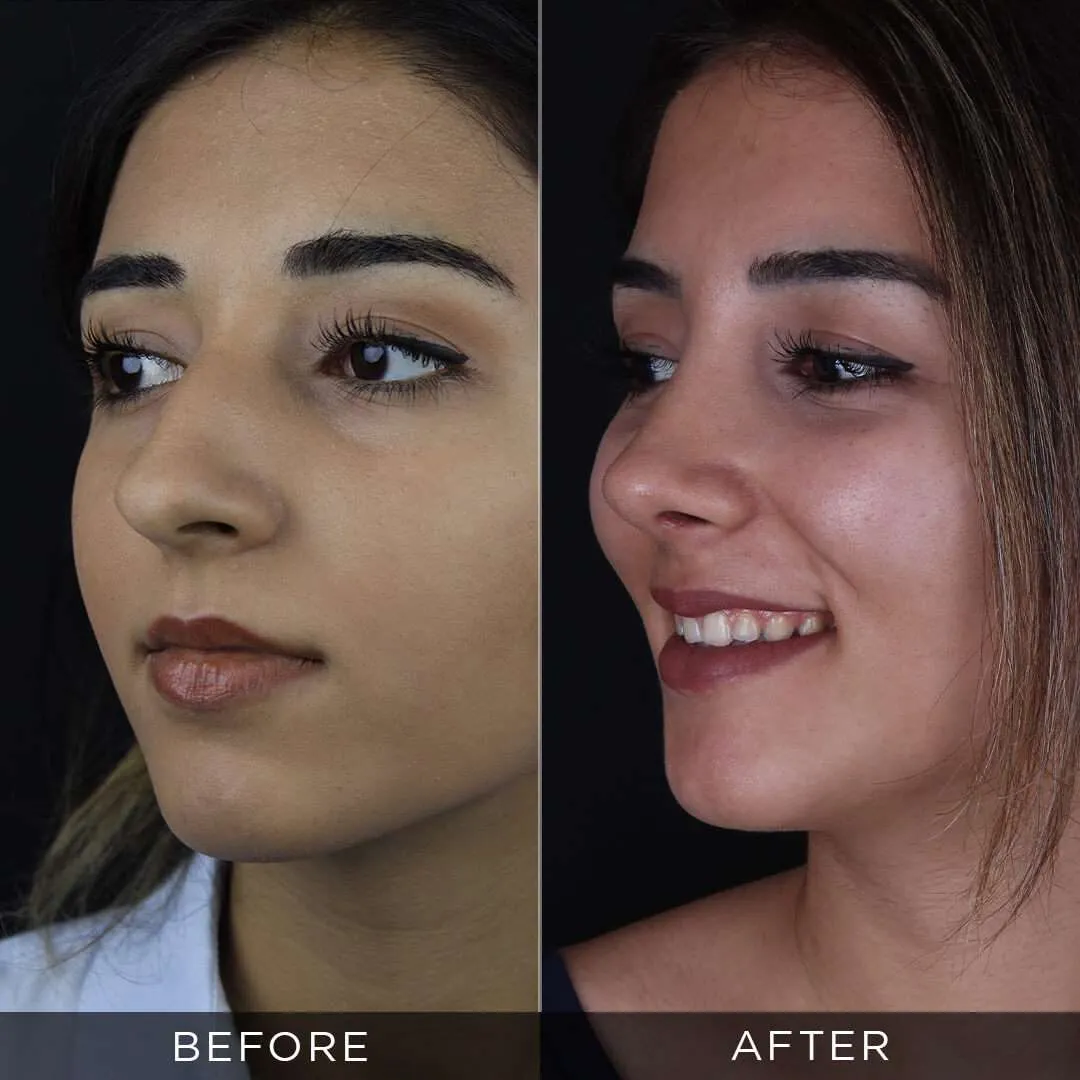 female piezzo rhinoplasty in istanbul