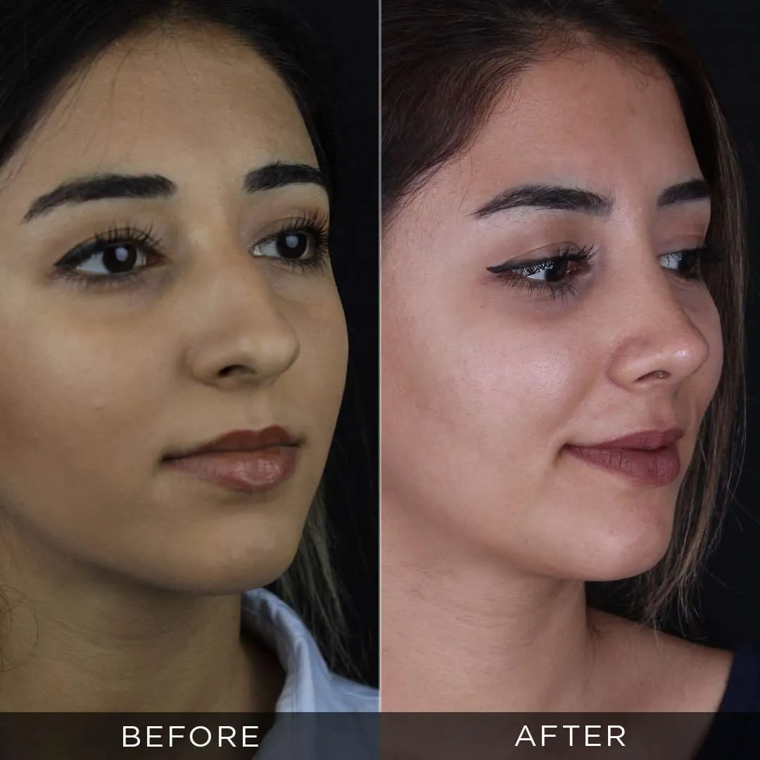 8 months after rhinoplasty at 25 years old