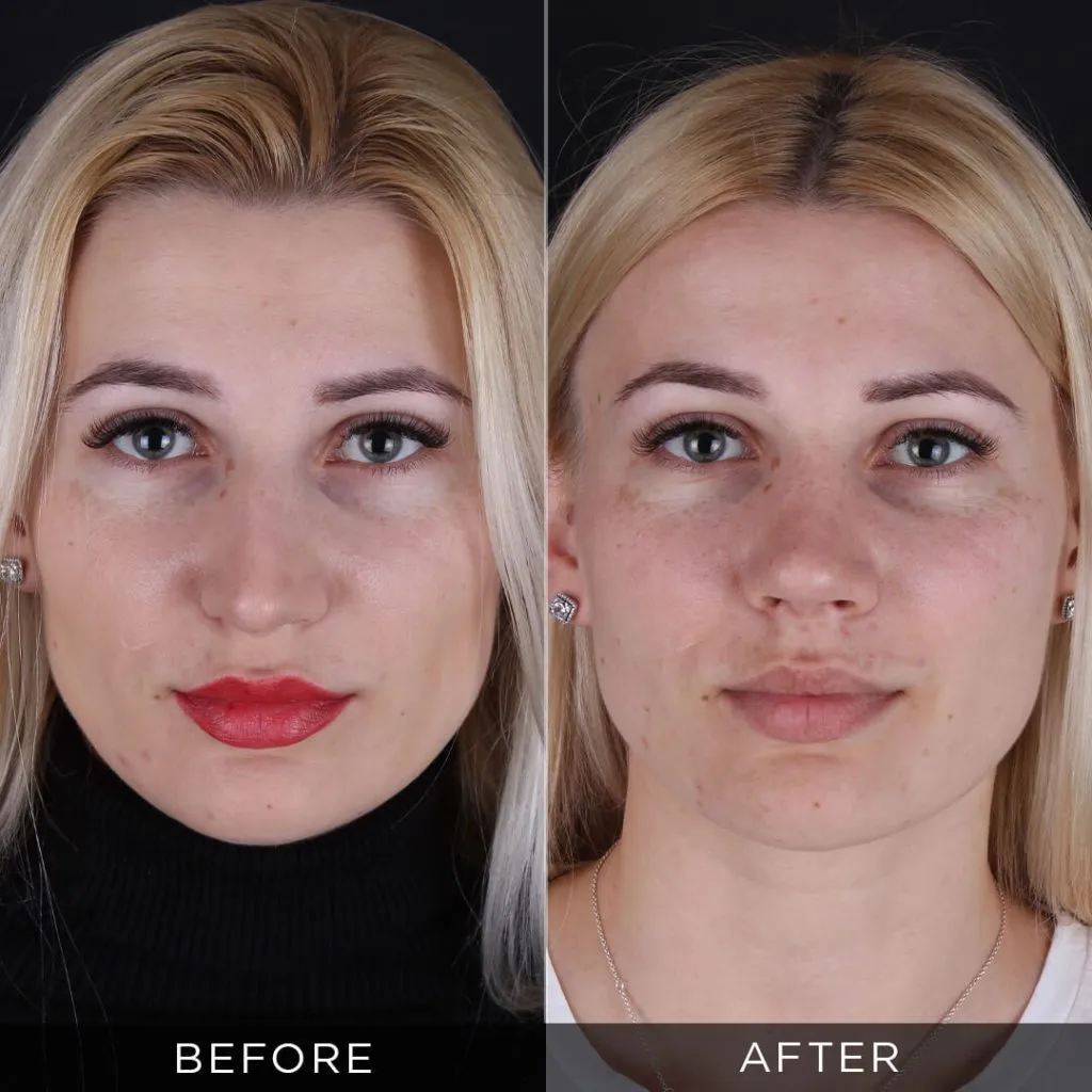 Piezo Rhinoplasty Turkey piezo-rhinoplasty-in-turkey
