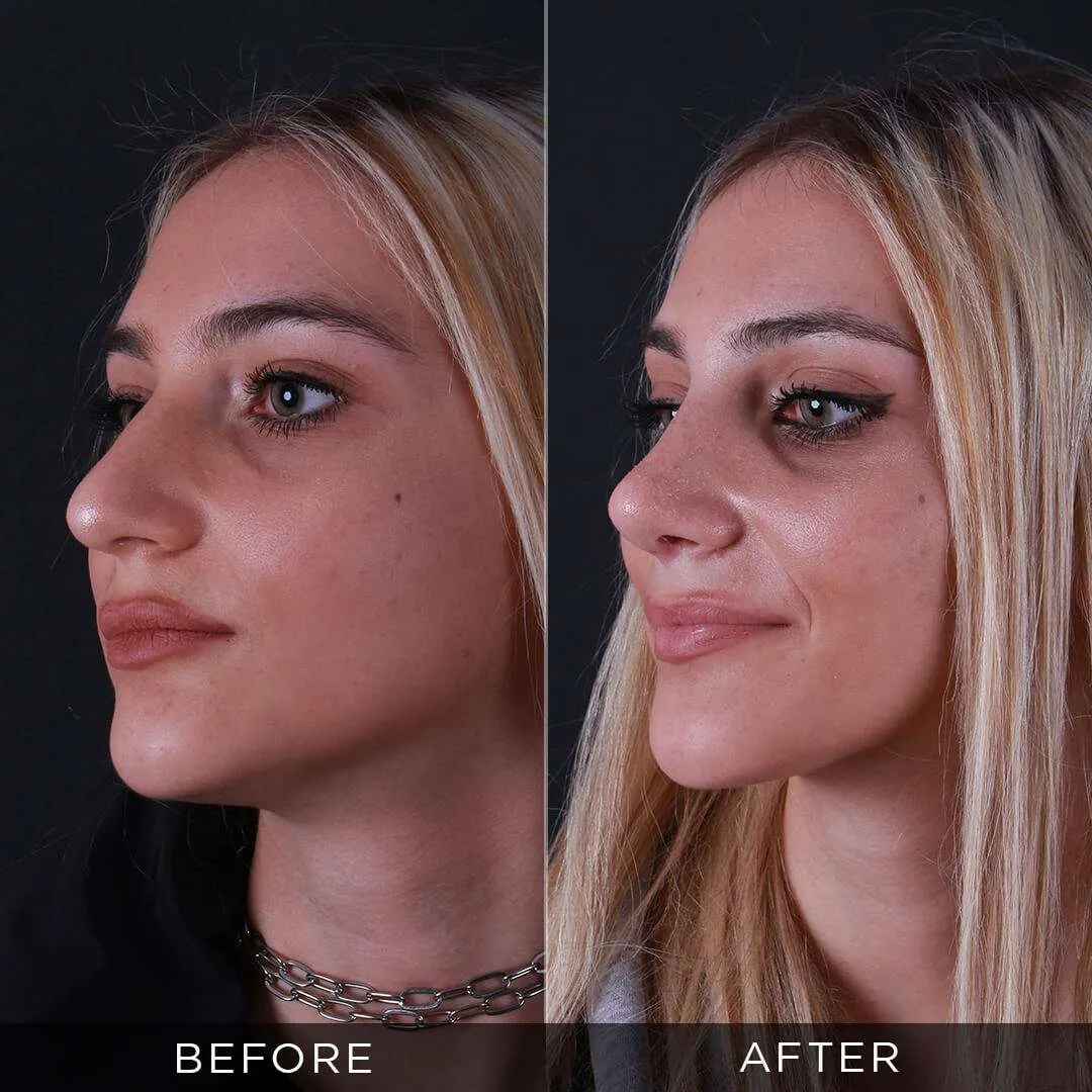 28 year old female piezzo rhinoplasty in istanbul