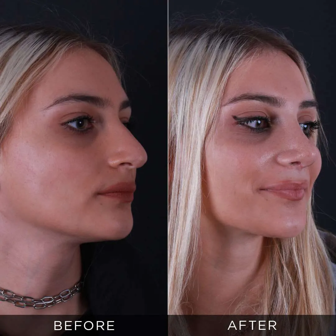 28 year old woman 3 weeks after rhinoplasty