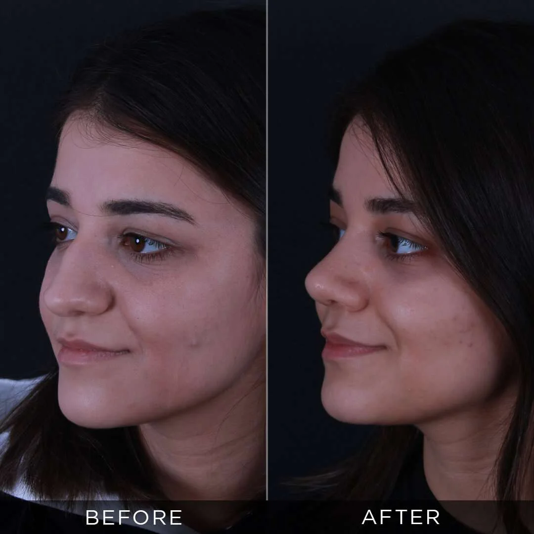 20 year old woman piezzo rhinoplasty in istanbul