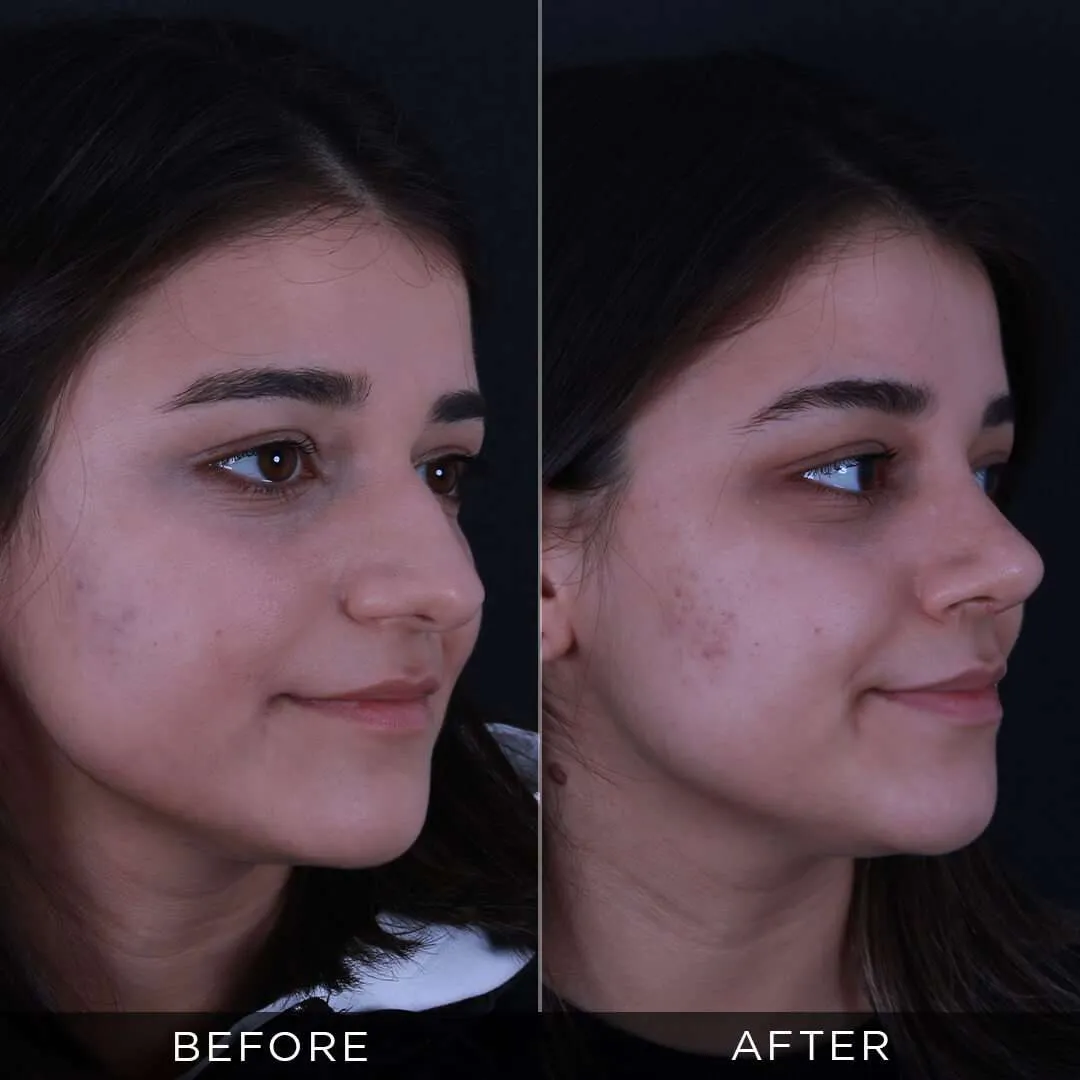 20 year old rhinoplasty in turkey