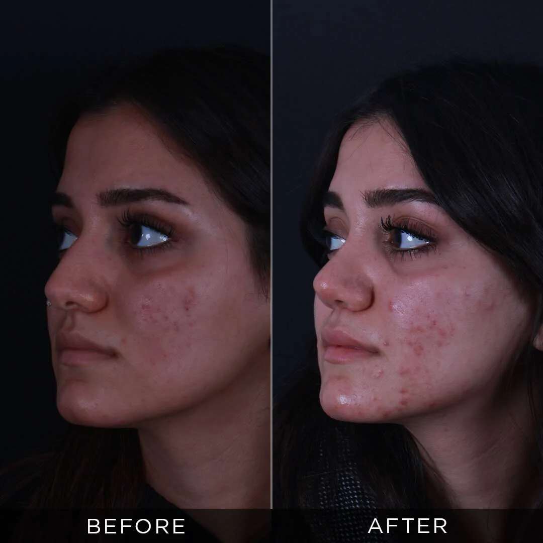 Septoplasty in Turkey 21 year old woman before and after rhinoplasty in Turkey