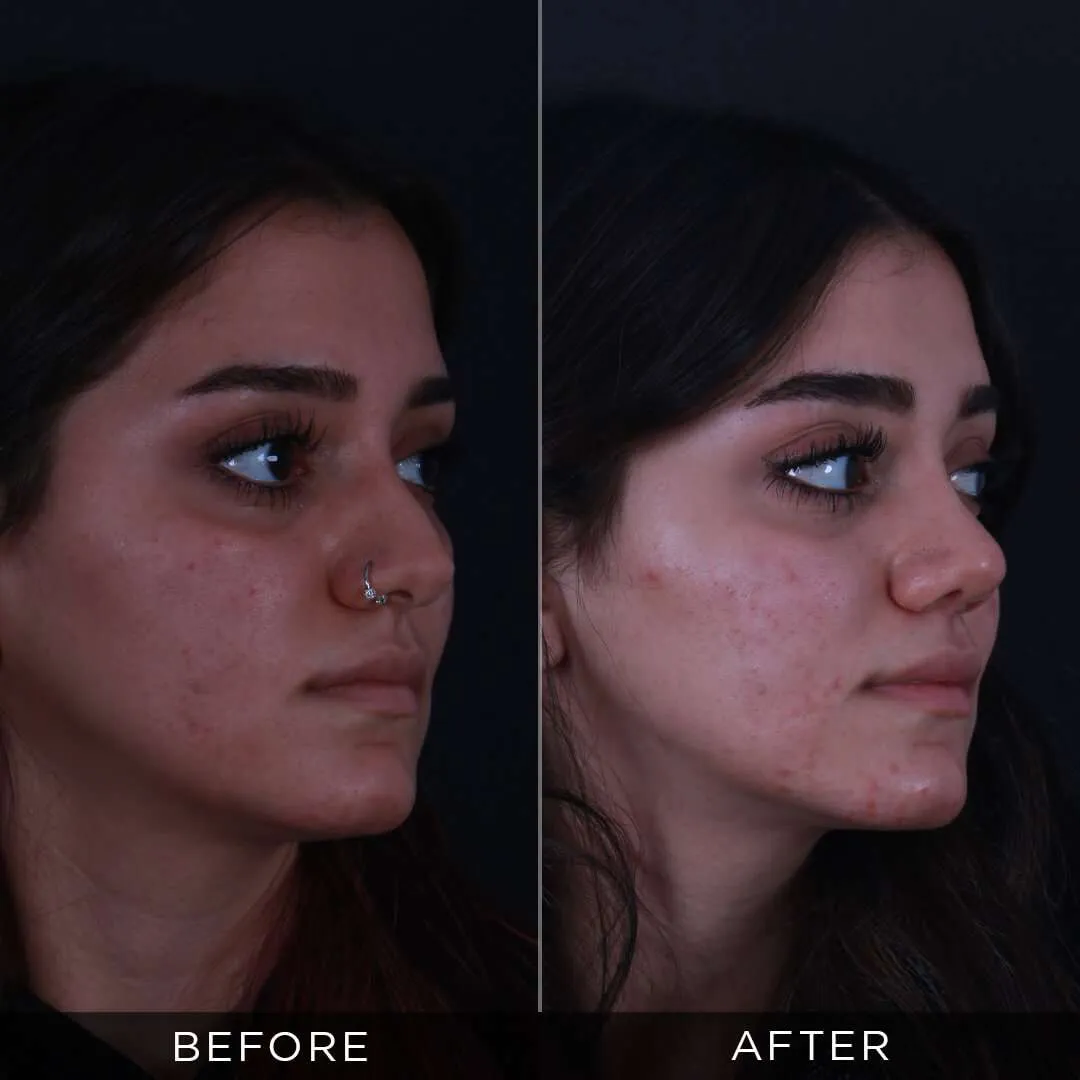 Septoplasty in Turkey 21 year old female rhinoplasty