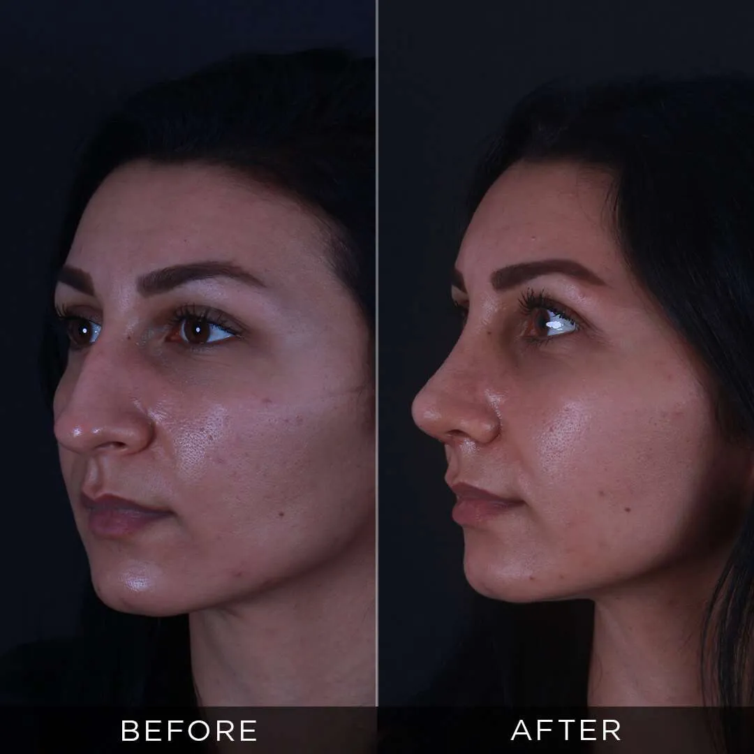 Piezzo rhinoplasty at 29 years old