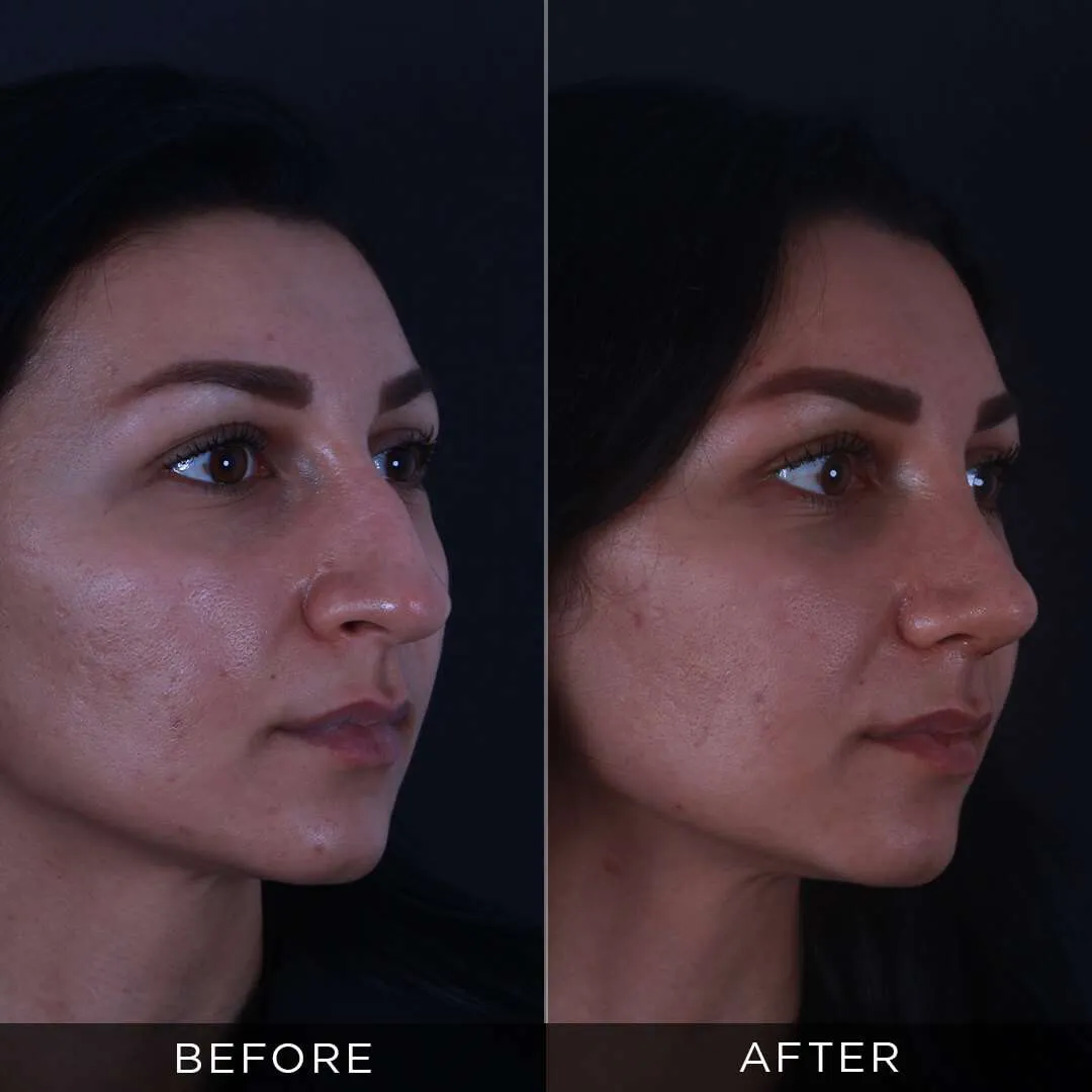29 years old one month after rhinoplasty in Turkey