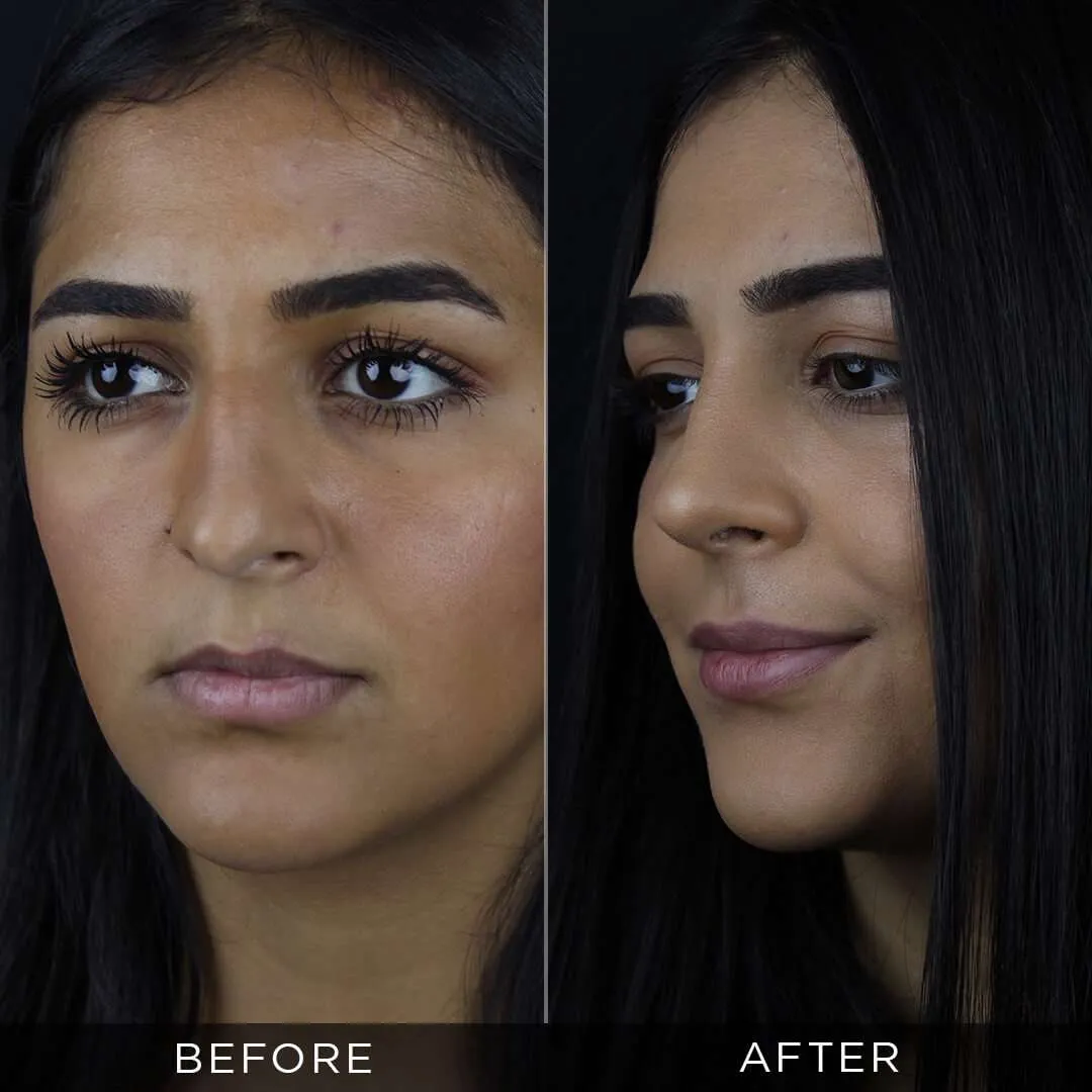 Septoplasty in Turkey 26 years old one year after rhinoplasty