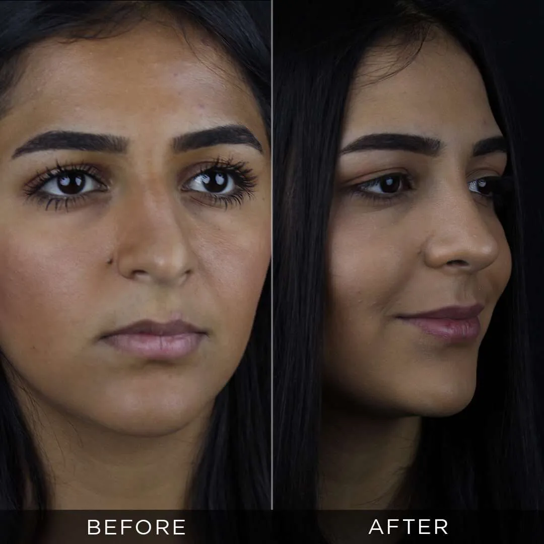 Septoplasty in Turkey 26 year old female one year after rhinoplasty