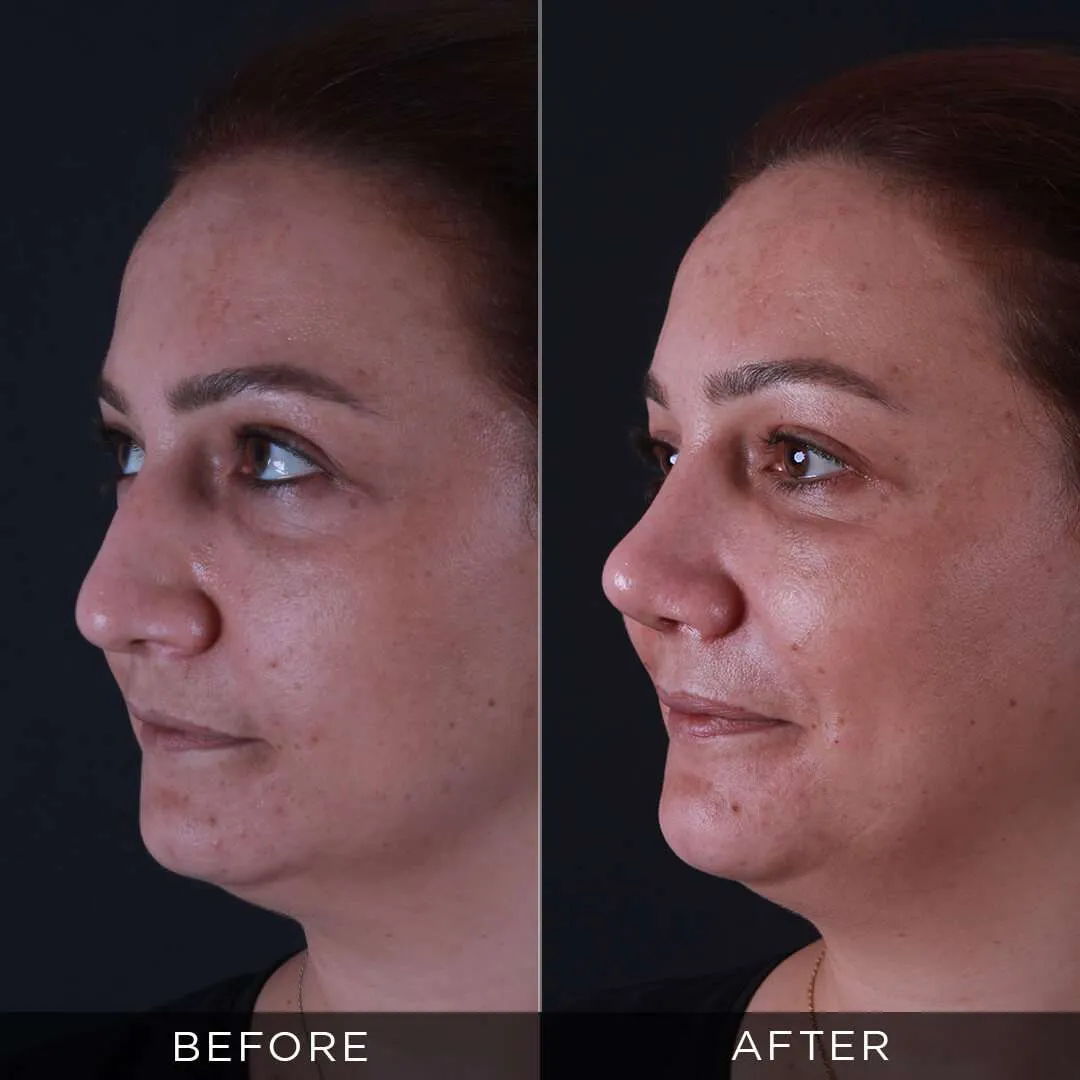 rhinoplasty for a 36 year old female in istanbul