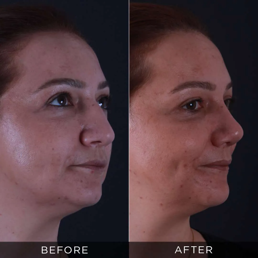 rhinoplasty-woman in turkey