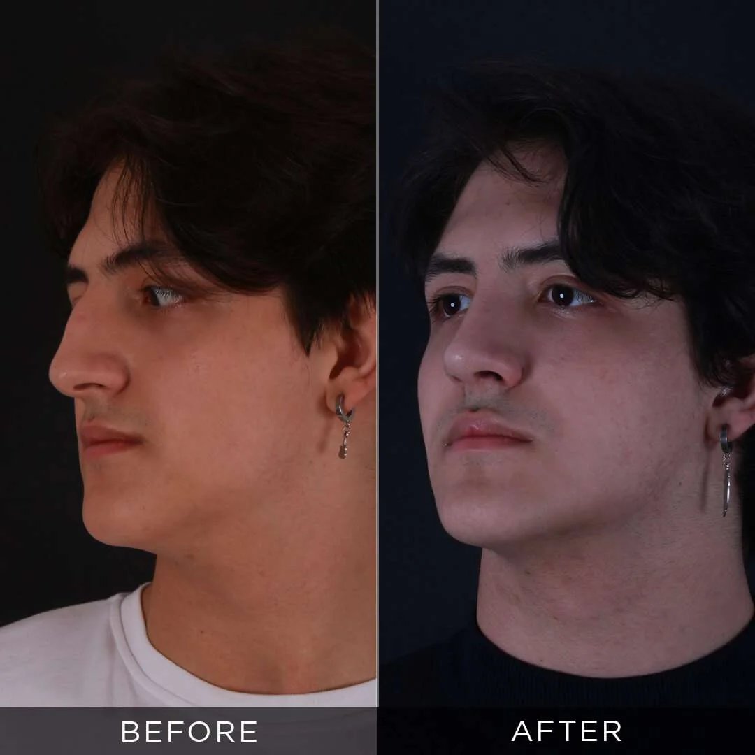 piezzo-male-rhinoplasty-in-istanbul