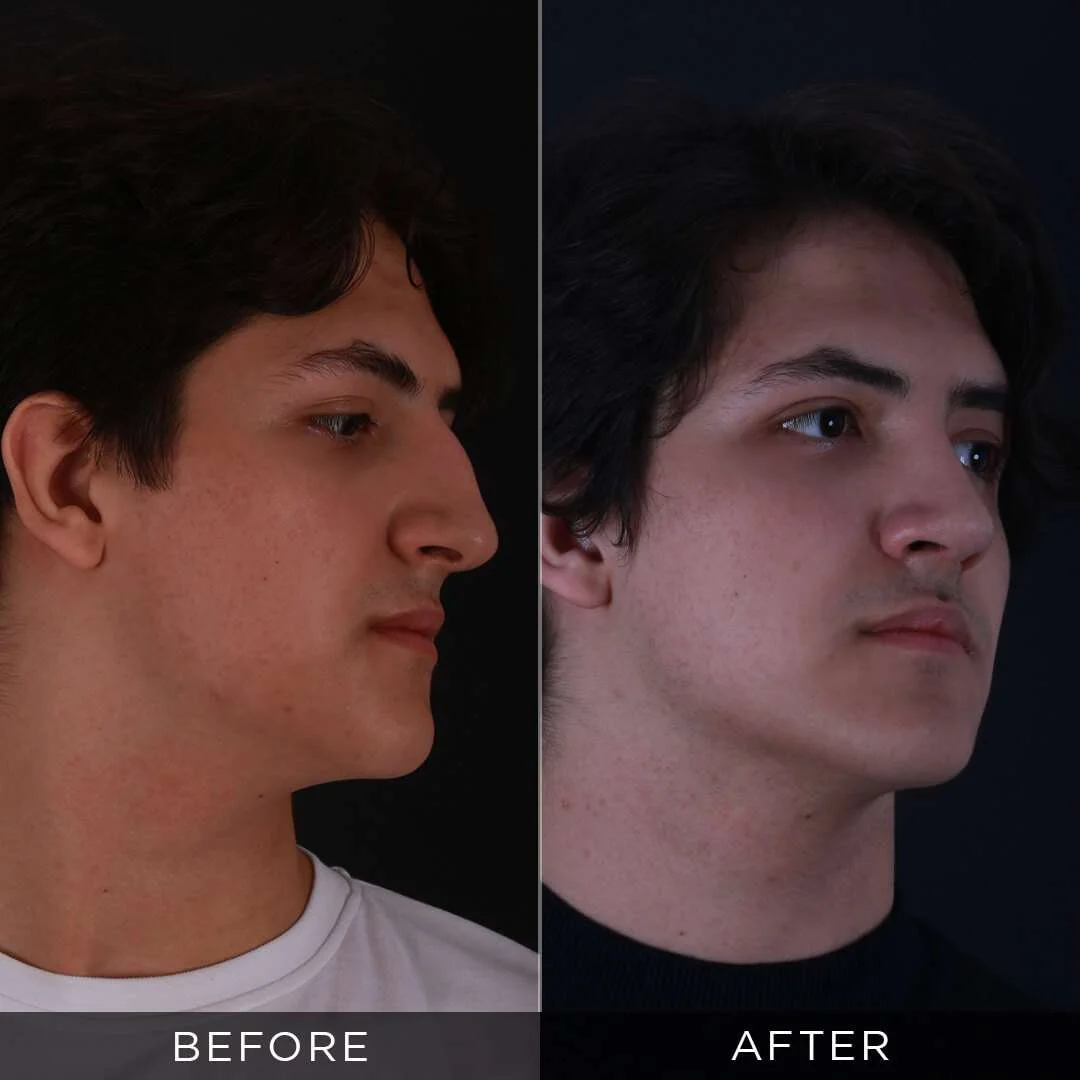 piezzo-male-rhinoplasty-in-turkey
