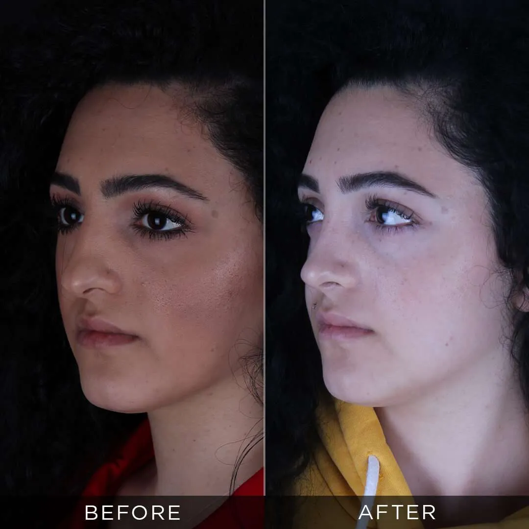before-and-after-pizzo-rhinoplasty-in-istanbul