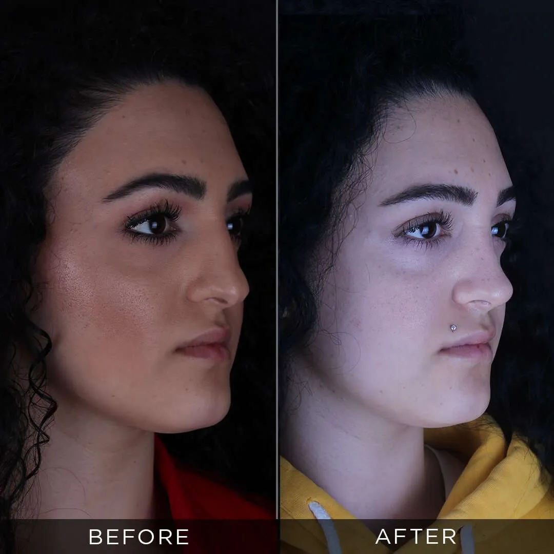 female before and after rhinoplasty