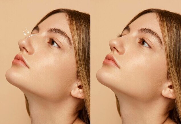 Septoplasty in Turkey septoplasty-in-turkey (1)