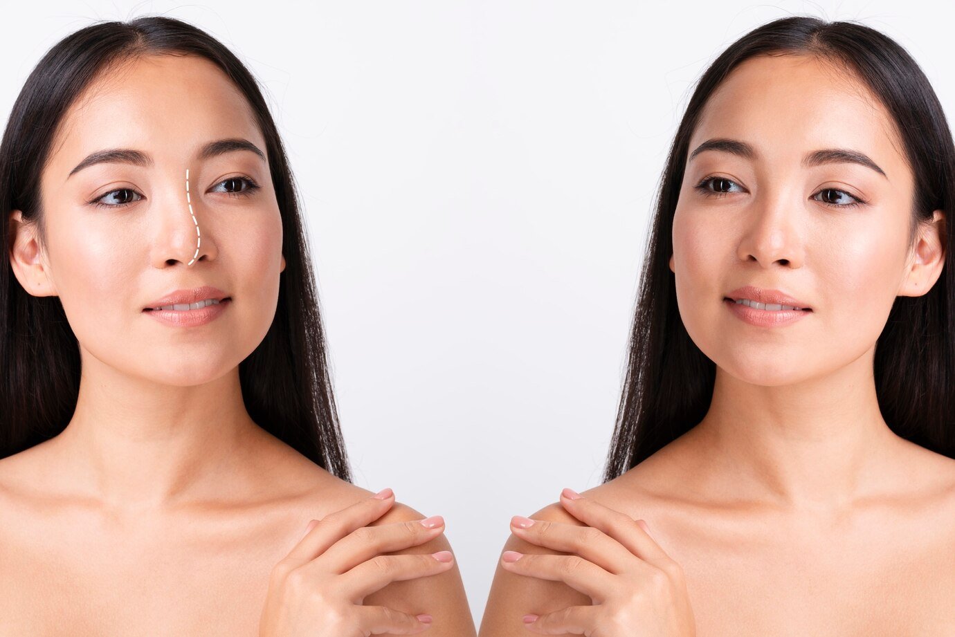 signs-of-a-bad-rhinoplasty