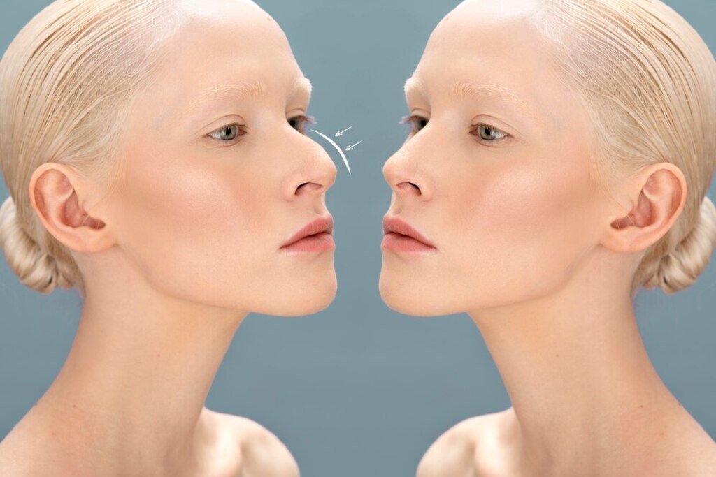 Blog thick-skin-rhinoplasty-in-turkey (1)