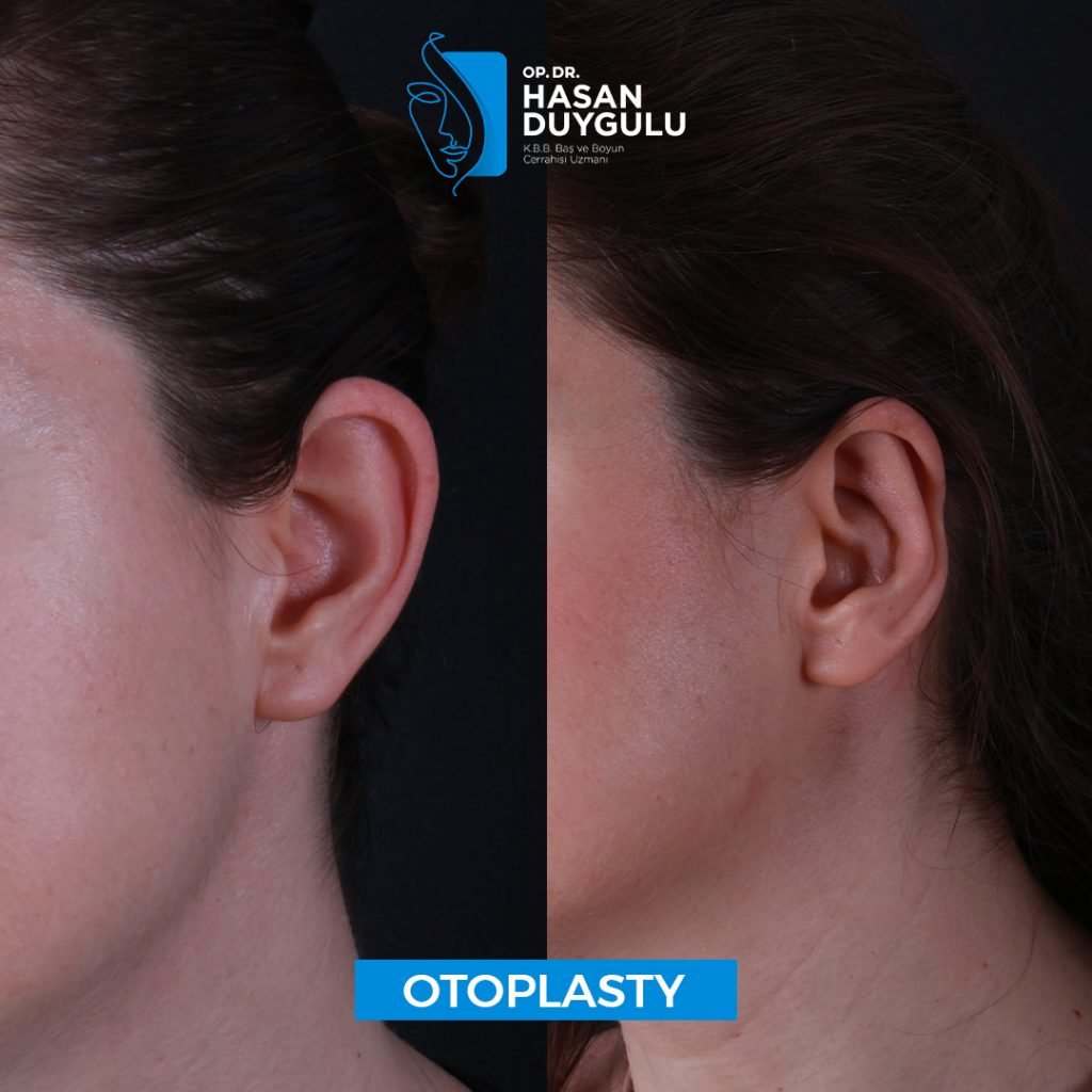 Revision Otoplasty