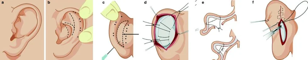 Otoplasty in Turkey Otoplasty in Turkey