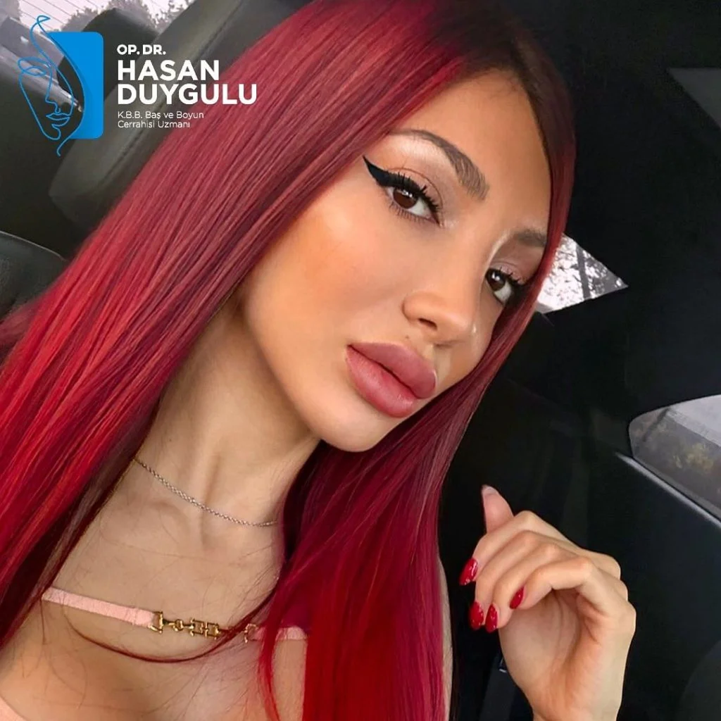 Kapalı Burun Ameliyatı kapalı burun estetiği fiyatları