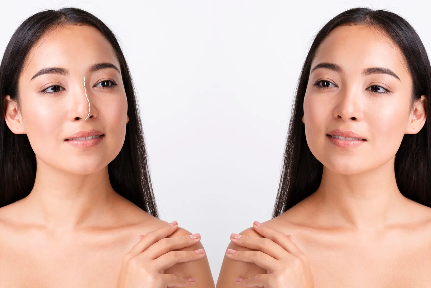 Başarısız Burun Estetiğinden Nasıl Kaçınılır?